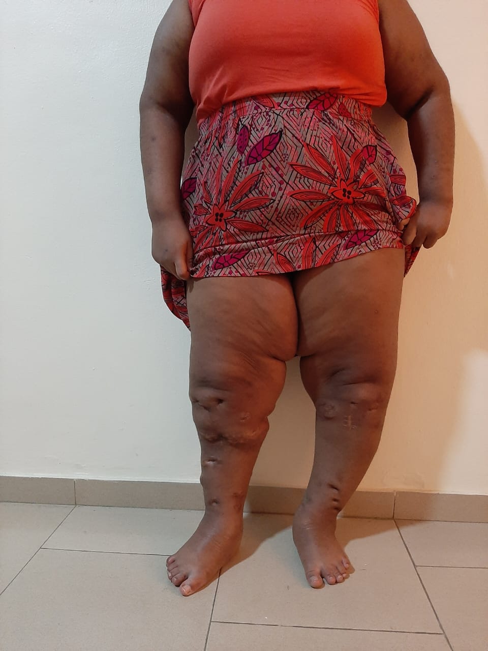 After: Corrective Osteotomy for Genu Varum